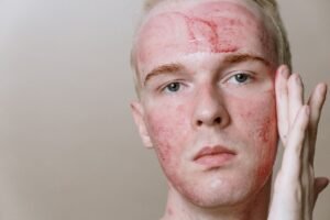 Skin Barrier Repair